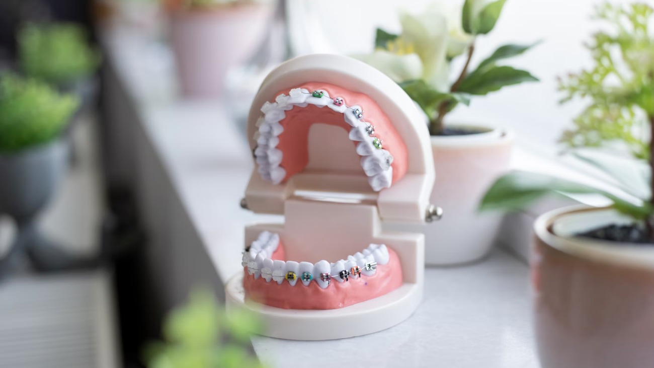 dental mold with braces